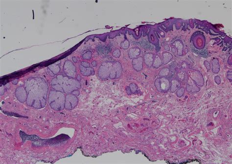 Fordyce Granules Histology - vrogue.co