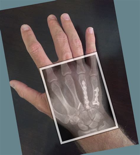 Metacarpal Fracture Treatment in Raleigh NC by Dr. Erickson