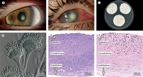 Contact lens-related fungal keratitis - The Lancet Infectious Diseases