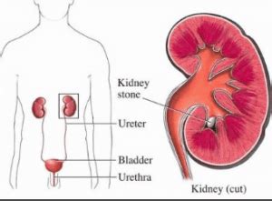 Urosepsis - Definition, Symptoms, Treatment, PathoPhysiology, Causes