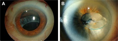 Evaluation and Management of Postoperative Complications Following Cataract Extraction and ...