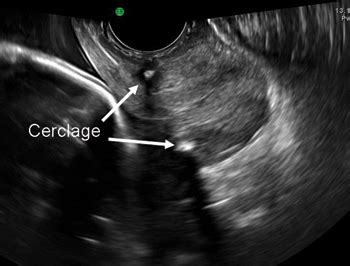 A stepwise approach to cervical cerclage | MDedge ObGyn