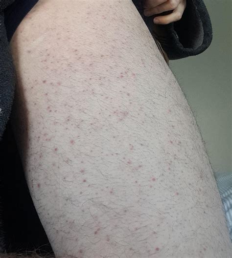 folliculitis on legs? : r/Folliculitis