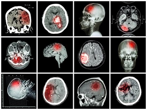 Lacunar infarct, a type of stroke: Causes, symptoms, and treatment options