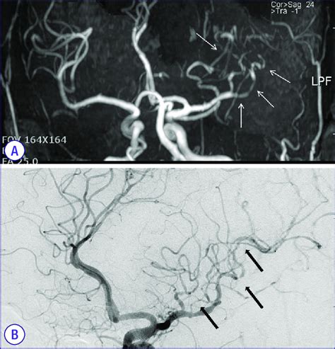 (A) MRI (B) Cerebral angiography. Scans demonstrate occlusion of ...