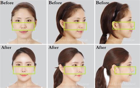 Your Guide to Getting Zygoma Reduction in Korea - Seoul Guide Medical