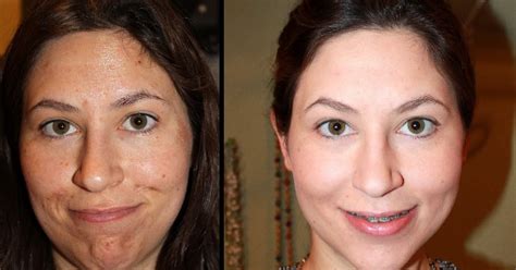 Jessner Peel Photos: A Blogger's Before & After Guide to Chemical Peels