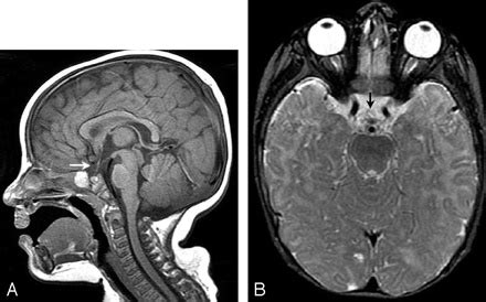 Fig 1. A, Midline sagittal T1-weighted image demonstrates absence of the optic chiasm (arrow ...