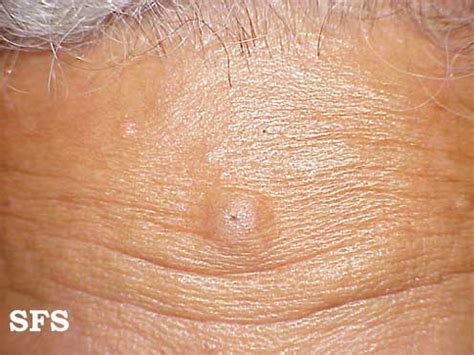 Epidermoid cyst - wikidoc