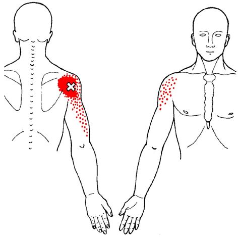 Deltoid Muscle: Location, Actions and Trigger Points - Ground Up Strength