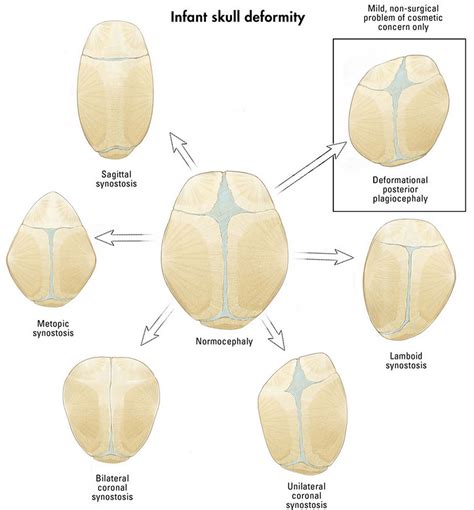 Craniosynostosis causes, symptoms, treatment & craniosynostosis surgery