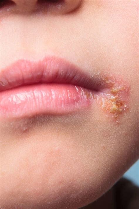 Infected blister: Symptoms, first aid, treatment, and healing