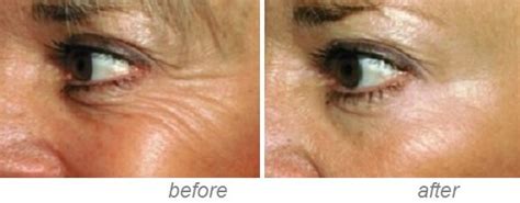 Botox & Dermal Fillers. Experienced Doctor | Malahide | Dublin