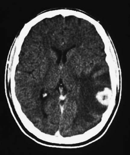 CT scan showing a single focal lesion with ring- enhancing and...