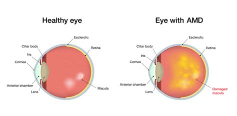 AMD Eye Treatment - I Sight Eye Care