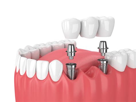 Tooth Implants: The Role Of The Abutment - Boulder County Smiles - Aesthetic & General Dentistry