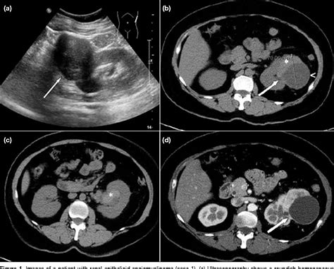 [PDF] Imaging Appearance of Renal Epithelioid Angiomyolipoma: a Rare ...