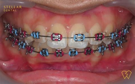 Braces Colors: Top Picks For 2023 - Stellar Dental