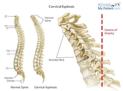 Zervikale Kyphose | KGSAU