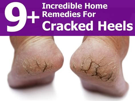 9+ Incredible Home Remedies For Cracked Heels