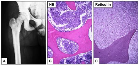 Cancers | Special Issue : Cancer-Associated Fibroblasts