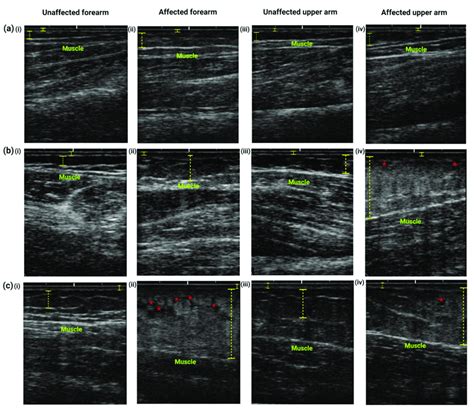 Typical images of ultrasound examination of the (i) unaffected forearm ...