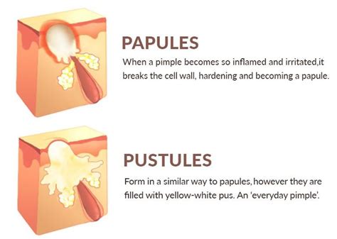 How To Get Rid Of Papules | Papules acne, Dry skin relief, Pustules acne