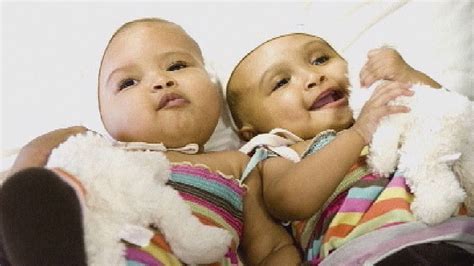 Conjoined twins successfully separated – Channel 4 News