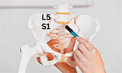 L5-S1 Pain and its Causes, Symptoms, and Treatment : Performance Pain ...