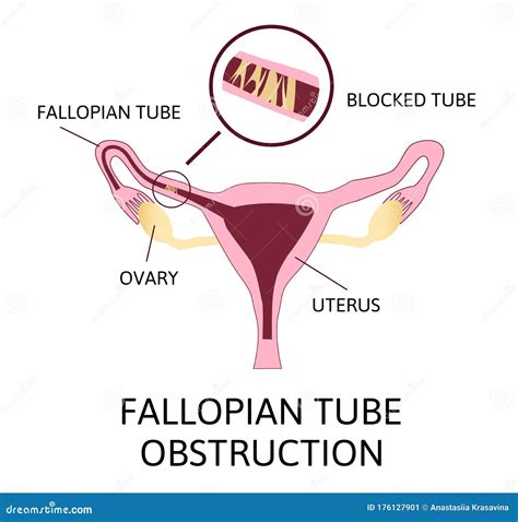 Fallopian Tube Obstruction or Blocked Fallopian Tubes Stock Vector ...