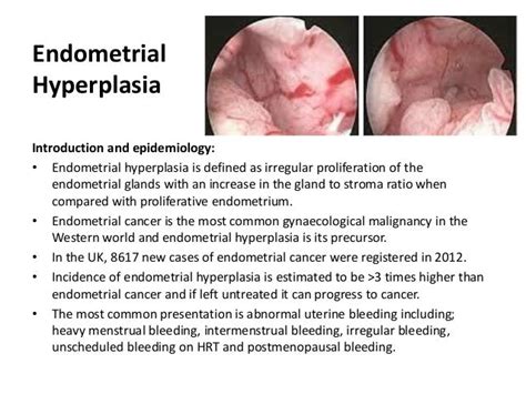 Endometrial Hyperplasia