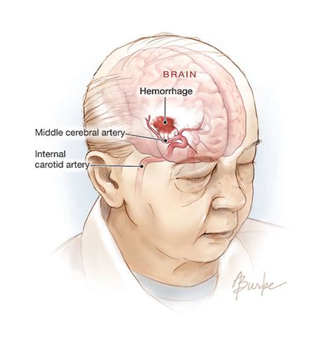 Hemorrhagic Stroke | Cerebrovascular Disease | JAMA | The JAMA Network