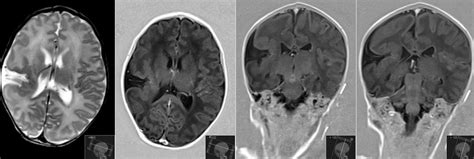 Radiology MRI: Schizencephaly Closed-Lip