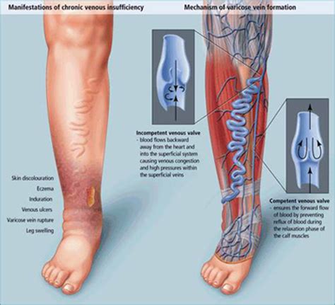 Varicose Veins - Symptoms, Causes And Treatment