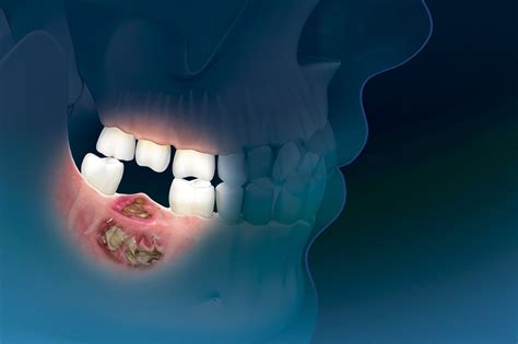 Oral Bisphosphonates Linked to 6-Fold Increase in Risk for Osteonecrosis of the Jaw ...