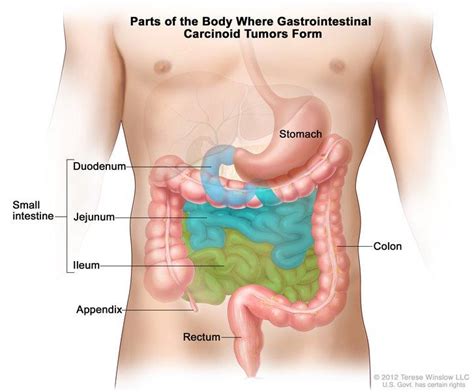 Appendix Cancers Genetically Distinct from Other GI Cancers - NCI