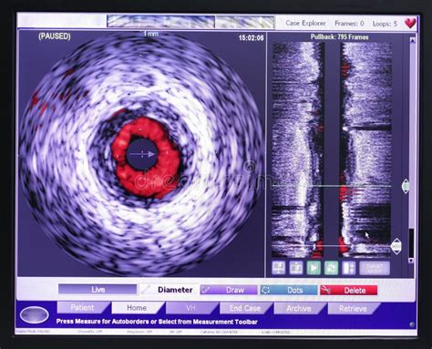 Intravascular Ultrasound Study. Stock Image - Image of endovascular, doctor: 34496973