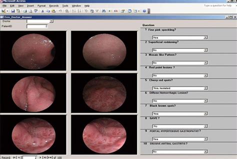 Reliability in endoscopic diagnosis of portal hypertensive gastropathy