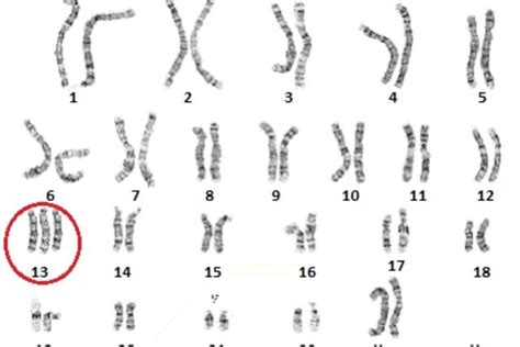 Cariotipo Del Sindrome De Down