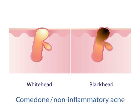 Types of comedone, non inflammatory acne vector on white background. Closed comedone, whitehead ...