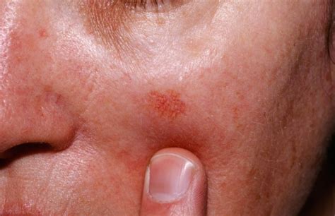 Actinic Keratosis - Causes, Symptoms & Actinic Keratosis Treatment