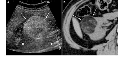 Angiomyolipoma, classic type, in a 61-year-old woman. Ultrasound (A)... | Download Scientific ...