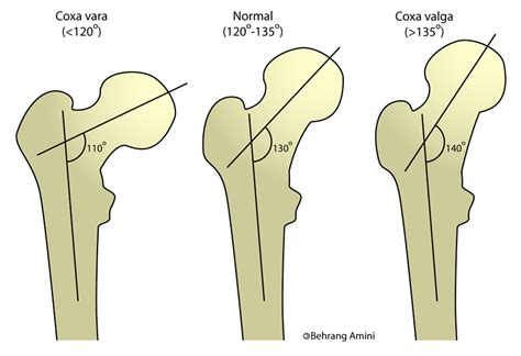 Coxa valga - wikidoc