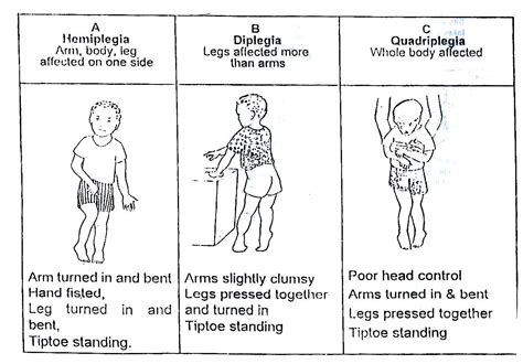 According to the WHO cerebral palsy (CP) is a disorder of muscle control that leads to ...