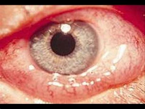 QUEMOSIS - INFLAMACIÓN O EDEMA DE LA CONJUNTIVA OCULAR - YouTube