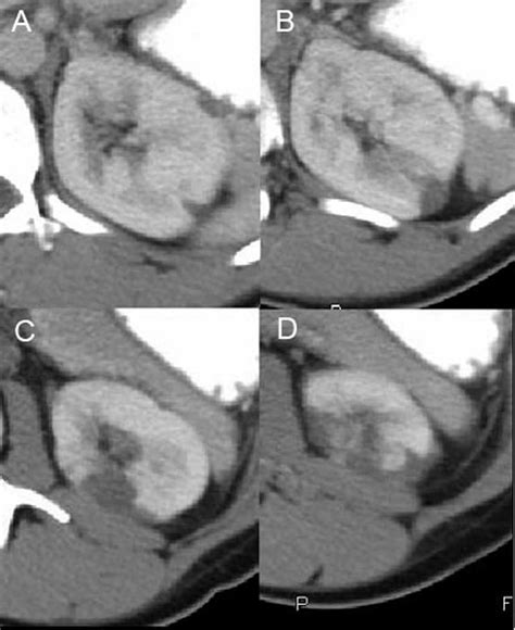 27­year­old woman with acute renal infarction. (A­D) CT scan with ...