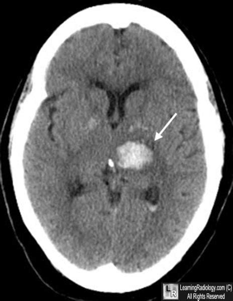 Learning Radiology - Hemorrhagic Stroke