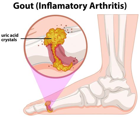 What Triggers Arthritis Flare Ups? – SAPNA Pain Management Blog