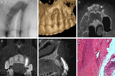 Diagnóstico diferencial entre el granuloma periapical y el quiste periapical – Dento Metric ...