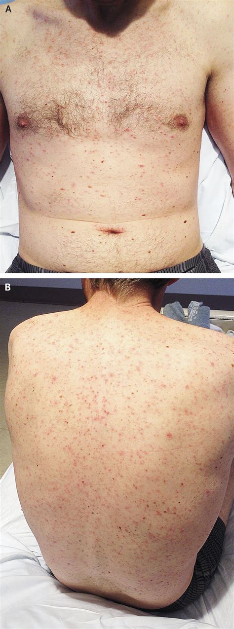 Case 23-2014 — A 41-Year-Old Man with Fevers, Rash, Pancytopenia, and ...